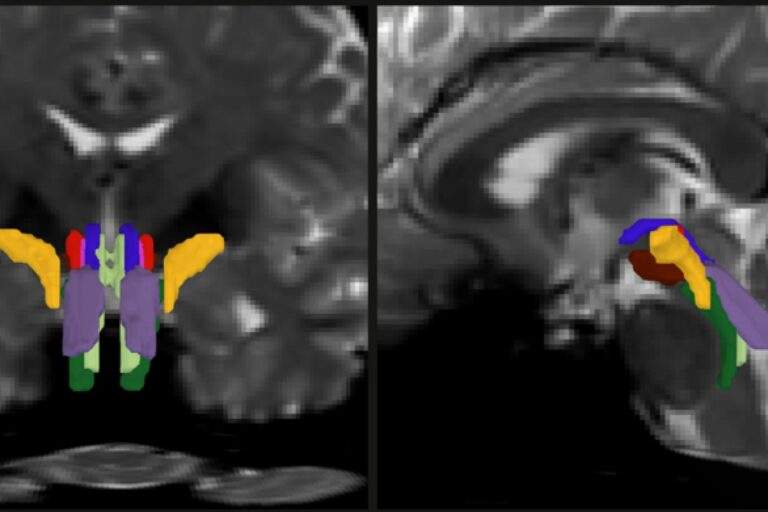 AI algorithm enables tracking of vital white matter pathways