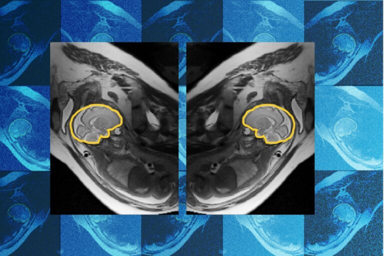 Why teaching AI about symmetry could make prenatal diagnosis more reliable Why teaching AI about symmetry could make prenatal diagnosis more reliable